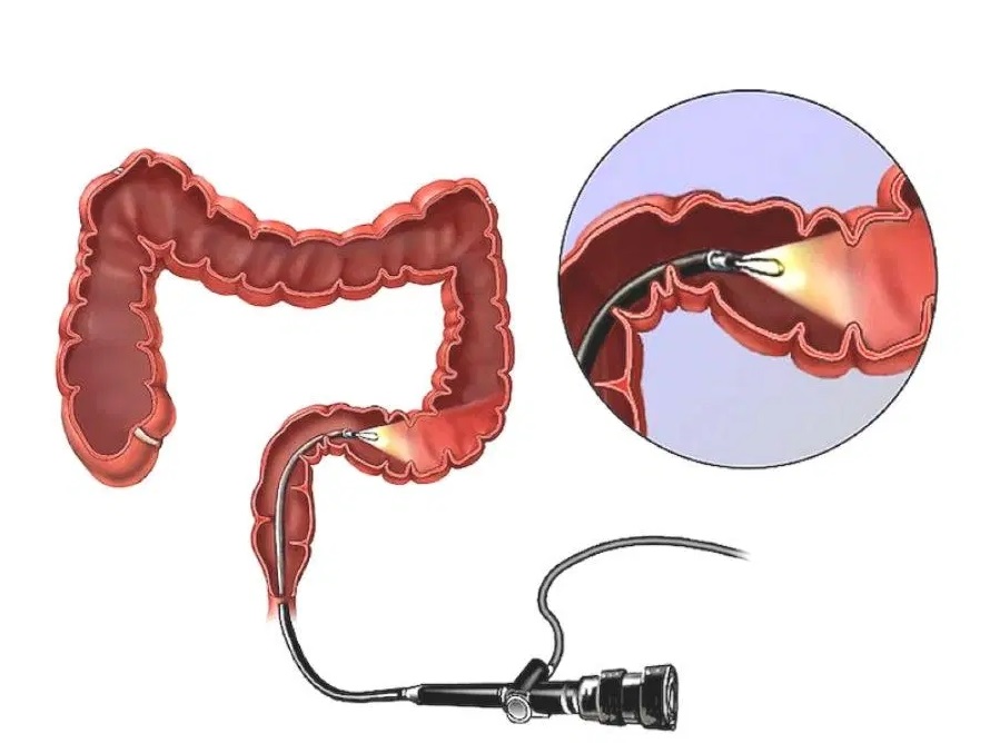 Колоноскопия кишечника